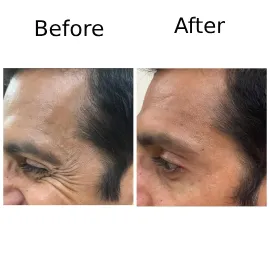 Skin Treatment