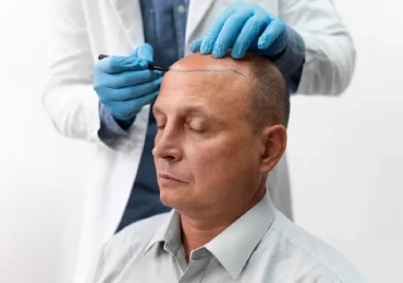 Hair Transplant Treatment